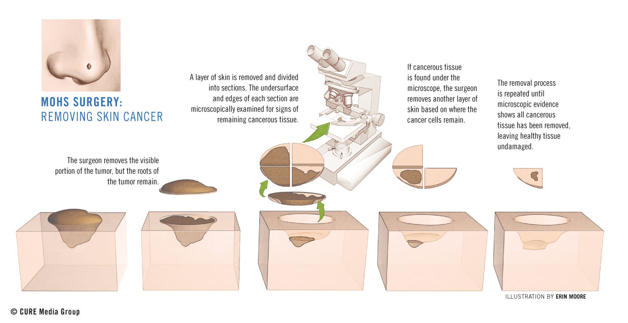 What is Mohs Micrographic Surgery?